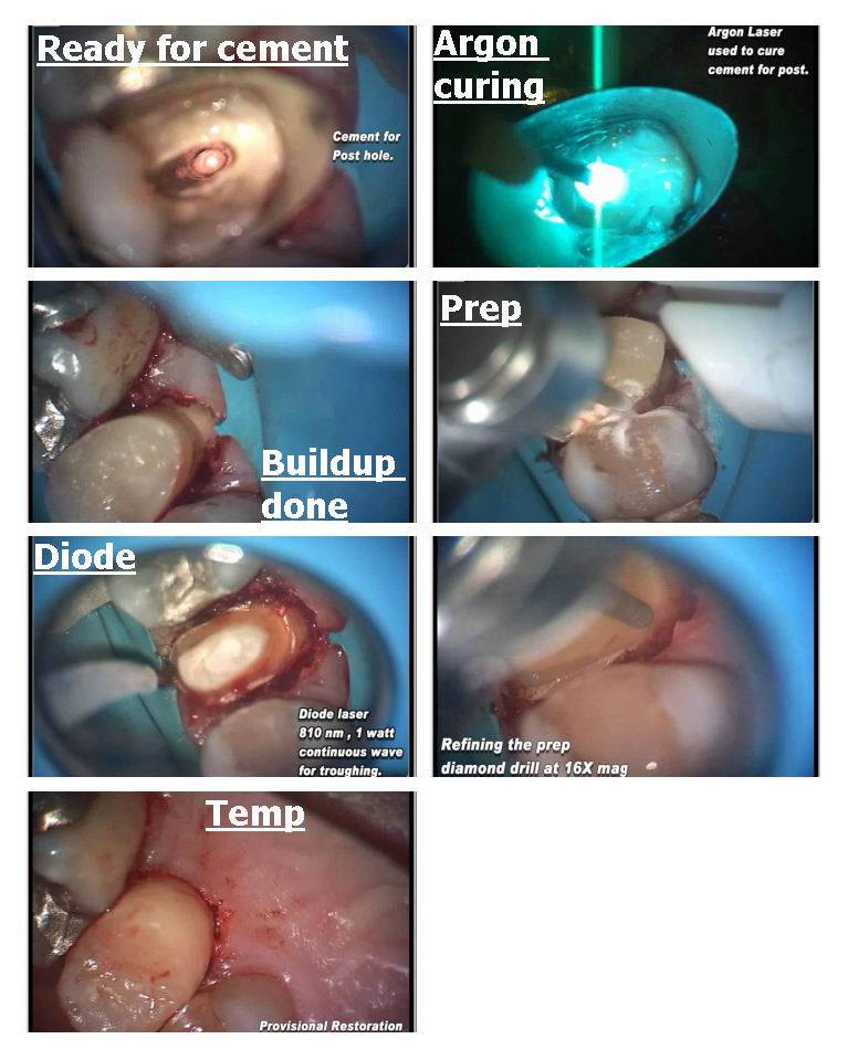 Page 2 of osseous recontouring.jpg